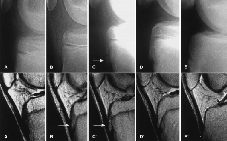 Obr. č. 9 – Porovnání rentgenového vyšetření a snímků magnetické rezonance normálního vývoje tuberositas tibiae