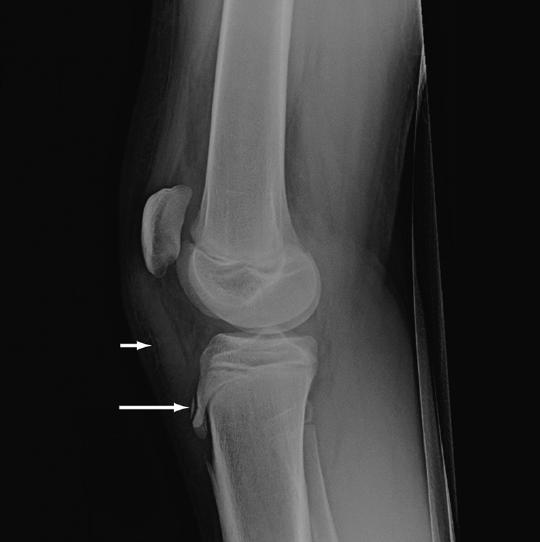 Obr. č. 7 – Boční rentgenový snímek kolene s nálezem M. Osgood-Schlatter